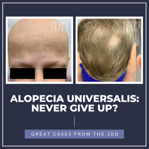 alopecia universalis