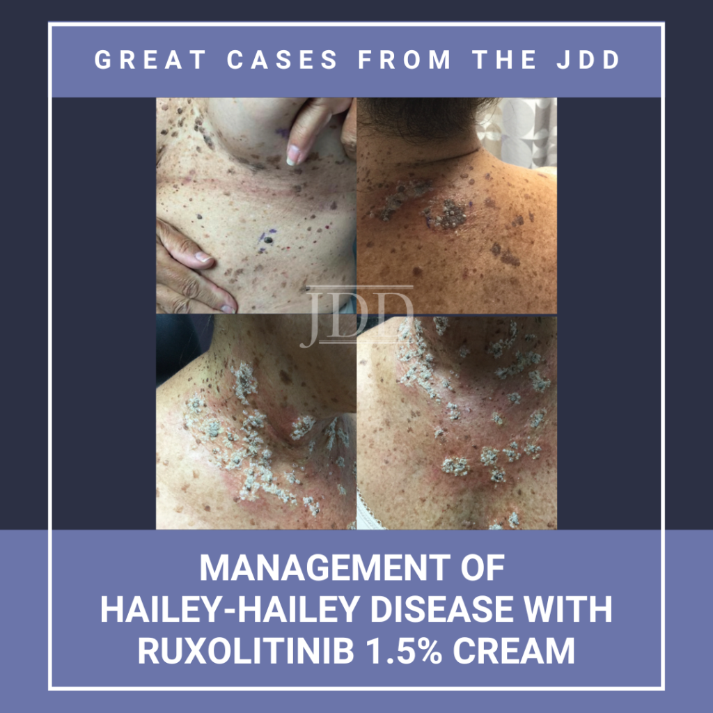 Management of Hailey-Hailey Disease With Ruxolitinib 1.5% Cream