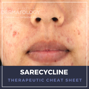 Sarecycline Therapeutic Cheat Sheet