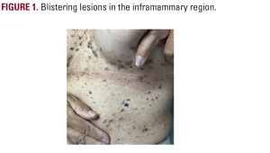 Hailey-Hailey Disease