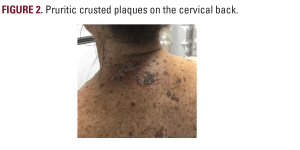 Hailey-Hailey Disease