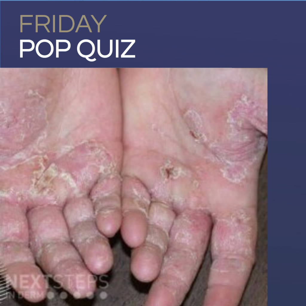 hand rash Archives - Next Steps in Dermatology