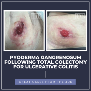 Pyoderma Gangrenosum