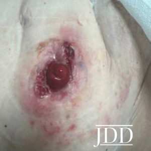 Pyoderma Gangrenosum