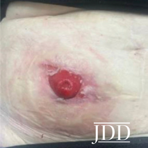 Pyoderma Gangrenosum