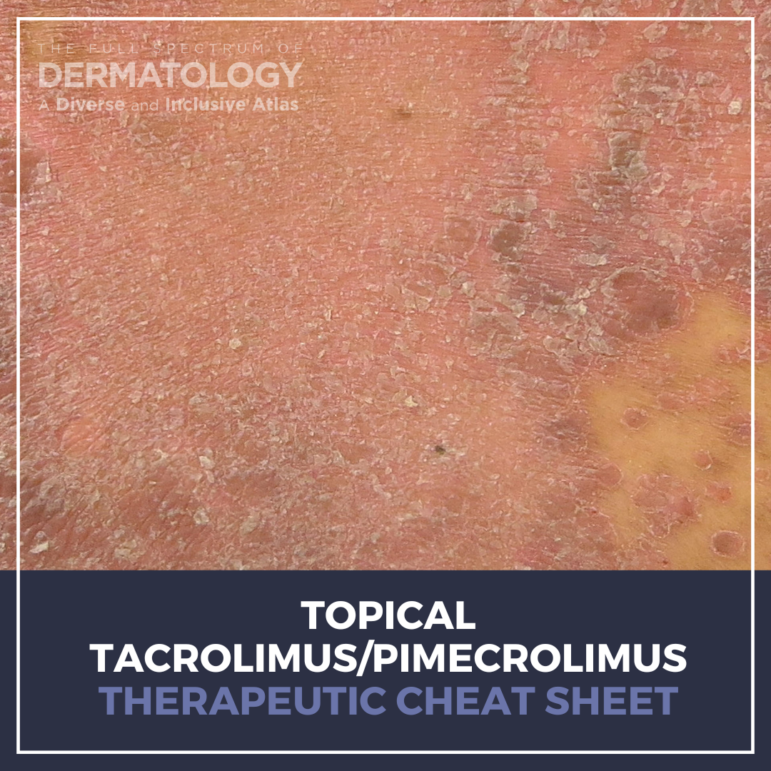 Topical Tacrolimus/Pimecrolimu Therapeutic Cheat Sheet
