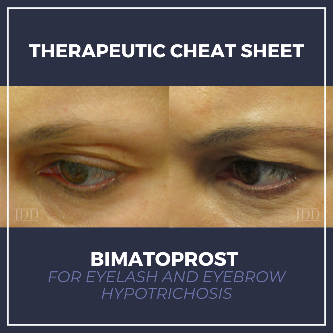 Bimatoprost