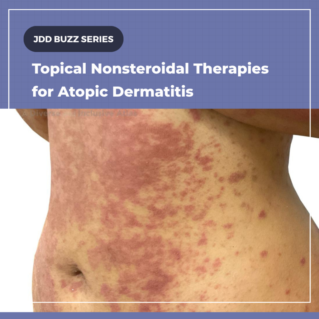 Topical Nonsteroidal Therapies for Atopic Dermatitis