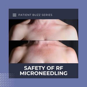RF microneedling