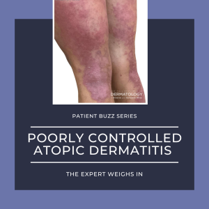 Patient Buzz_Poorly Controlled AD Poorly Controlled Atopic Dermatitis (AD)