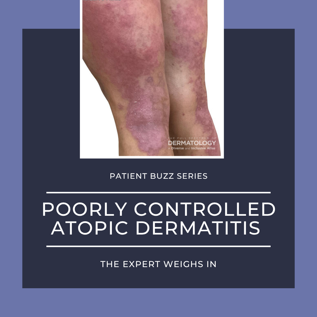 Poorly Controlled Atopic Dermatitis (AD)