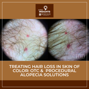 Dermoscopic view of the scalp used in an article about treating hair loss in skin of color, featuring expert insights on OTC and procedural alopecia solutions.