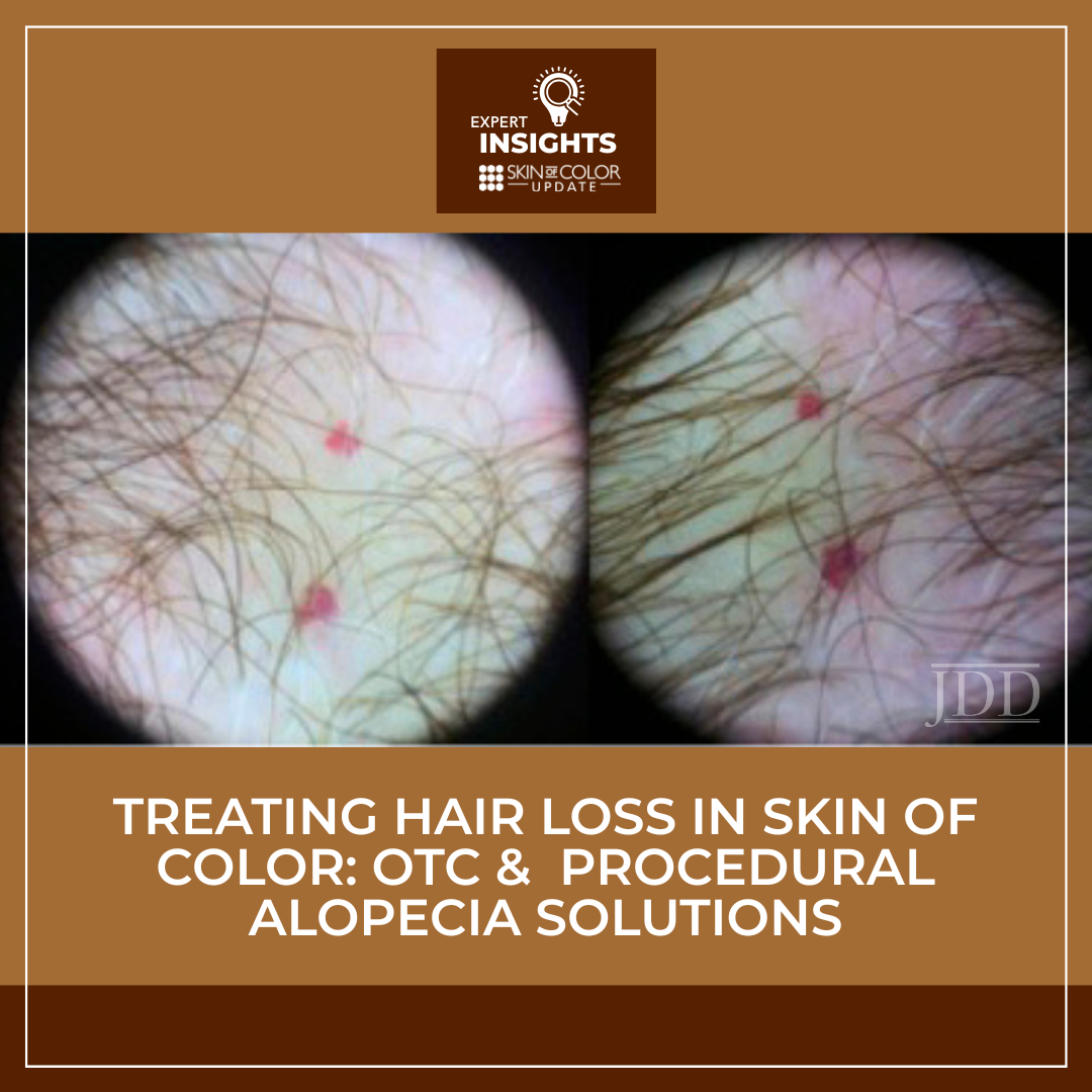Dermoscopic view of the scalp used in an article about treating hair loss in skin of color, featuring expert insights on OTC and procedural alopecia solutions.
