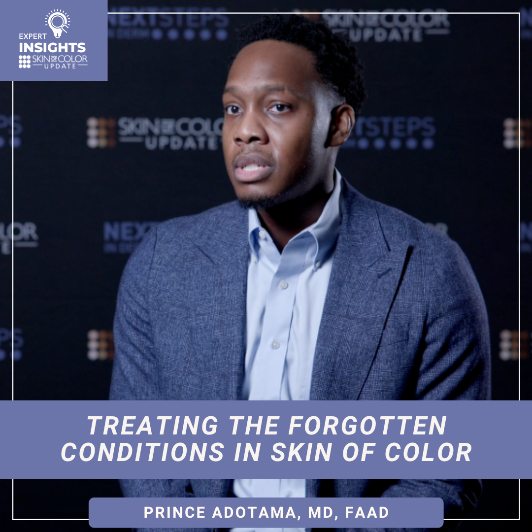 Dr. Prince Adotama, MD, FAAD, assistant professor at NYU Langone, discussing the treatment of acne keloidalis nuchae and dissecting cellulitis in an interview for Next Steps in Derm.
