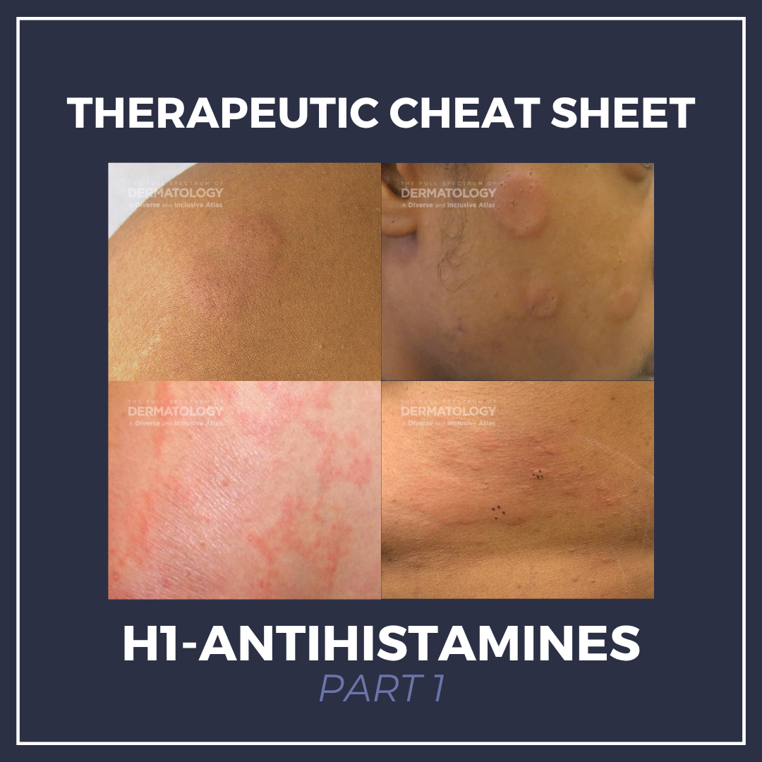 Clinical presentation of chronic spontaneous urticaria on patient skin, showing erythematous wheals and hives, illustrating the primary dermatologic indication for H1-antihistamine therapy.