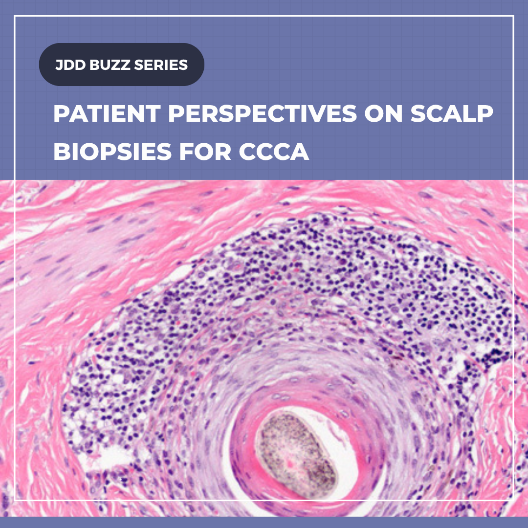 A graphic featuring the text 'PATIENT PERSPECTIVES ON SCALP BIOPSIES FOR CCCA' over a microphotograph of a scalp biopsy sample showing inflammatory cells around a hair follicle.