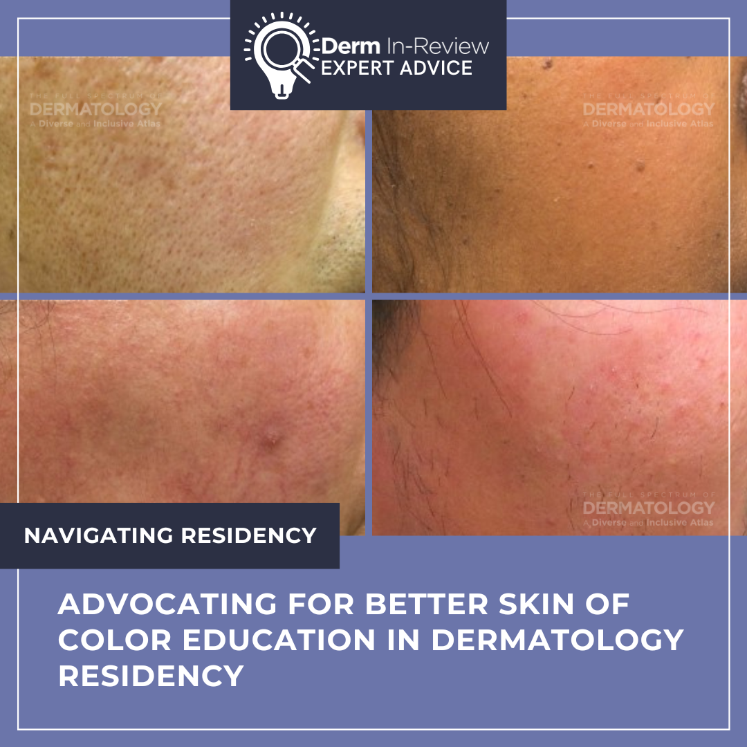 Derm In-Review expert advice graphic titled "Advocating for Better Skin of Color Education in Dermatology Residency" featuring a four-panel clinical comparison of dermatologic conditions across various skin tones to highlight the importance of diverse medical training.