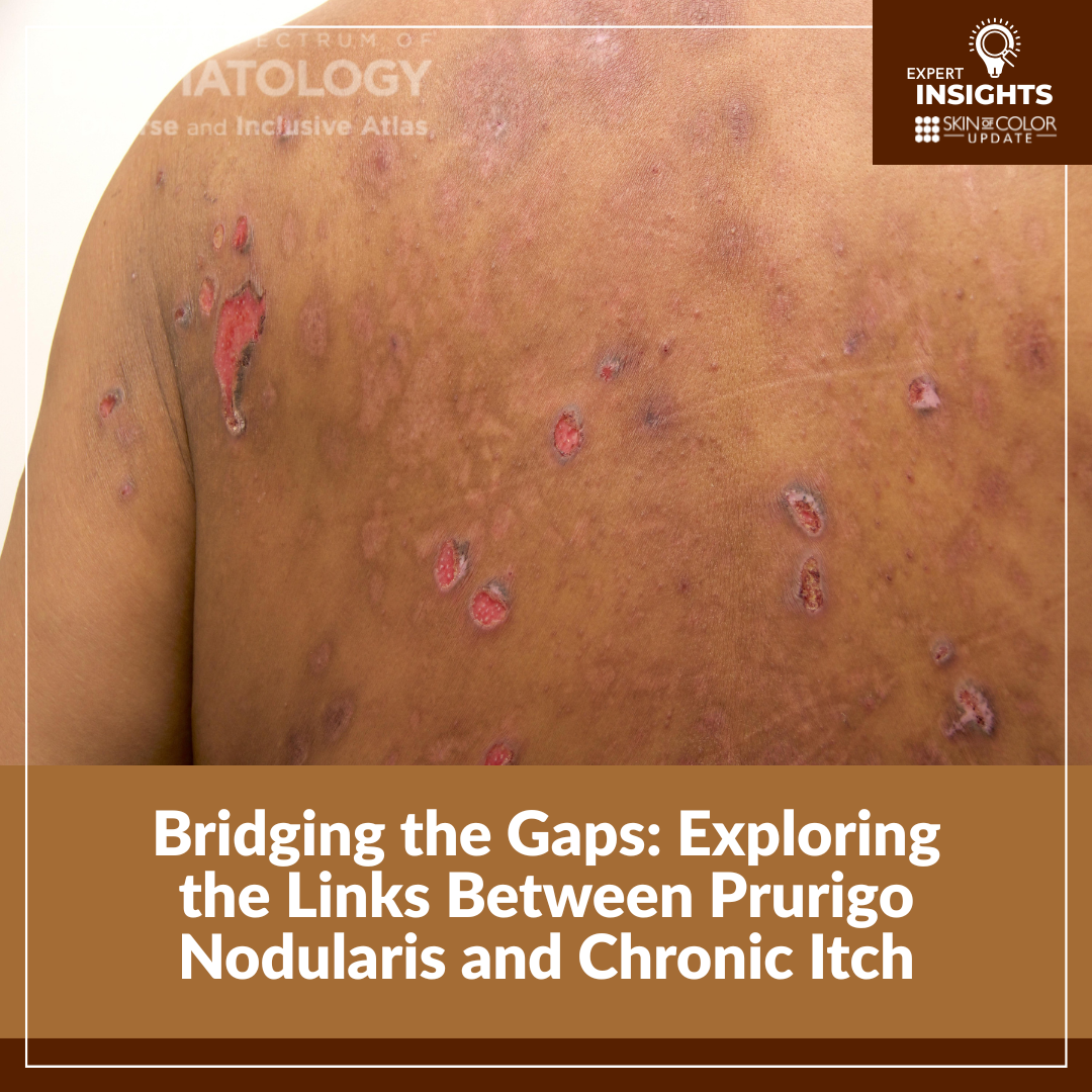 image of a skin of color male with prurigo nodularis (PN) on his back