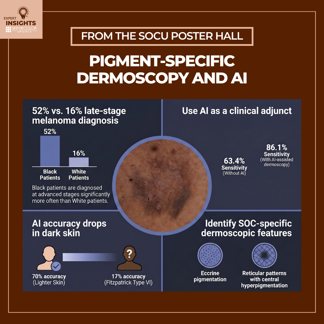 Infographic from the SOCU Poster Hall on Pigment-Specific Dermoscopy and AI showing melanoma diagnostic disparities: 52% late-stage diagnosis in Black patients vs. 16% in White patients. It highlights that AI accuracy drops from 70% in lighter skin to 17% in Fitzpatrick Type VI and identifies SOC-specific features like eccrine pigmentation.