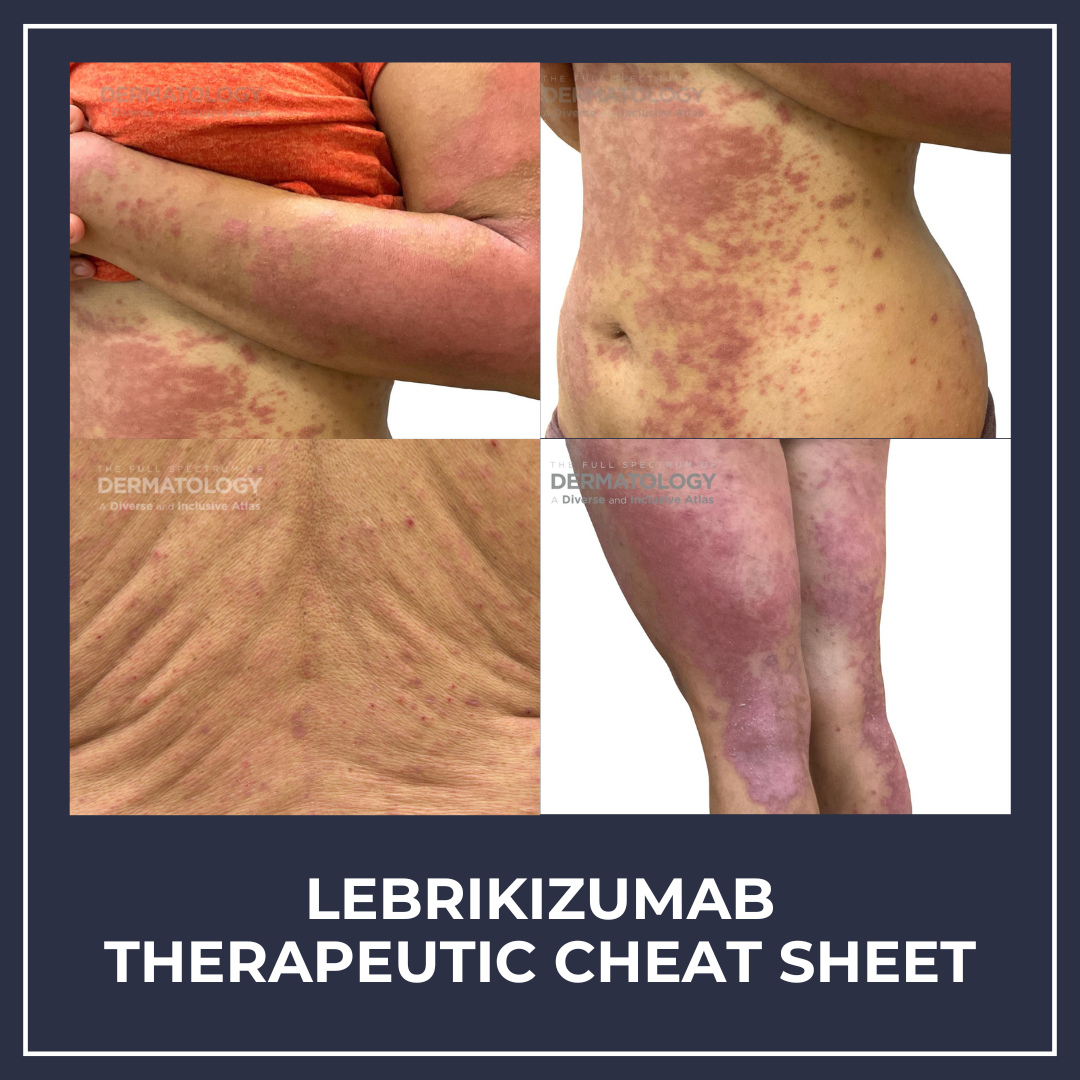 Lebrikizumab Therapeutic Cheat Sheet