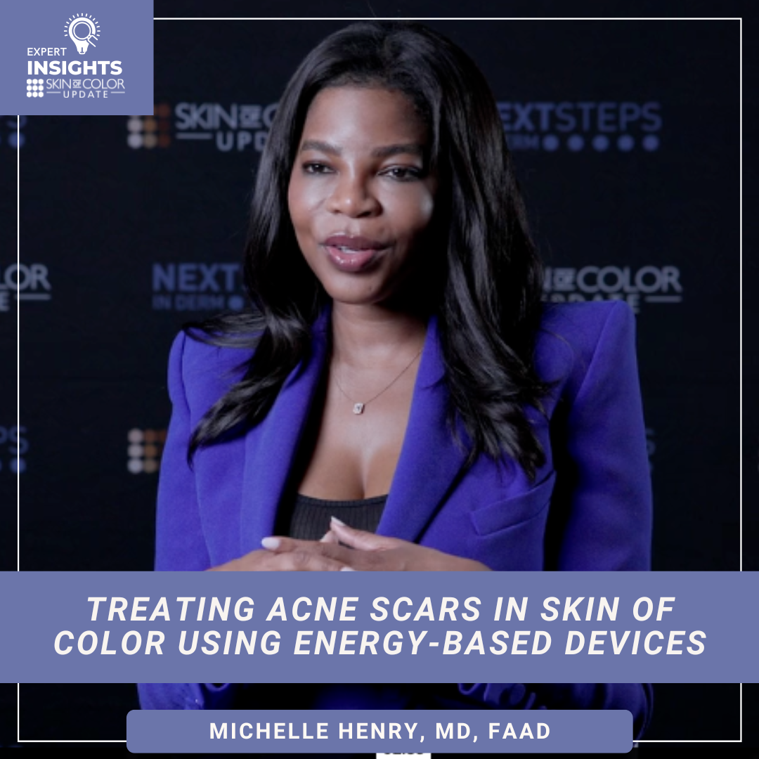 Treating Acne Scars in Skin of Color