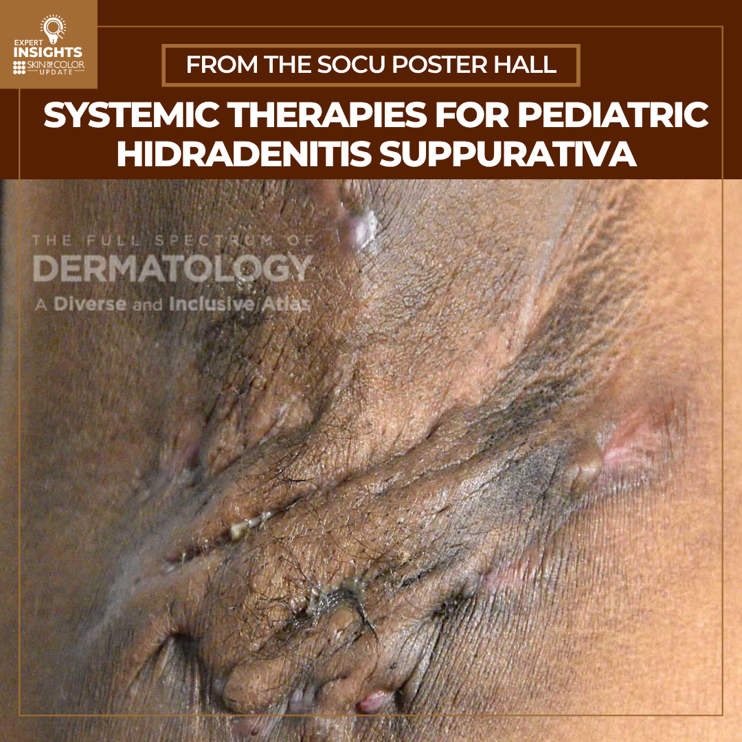 hidradenitis suppurativa (HS)
