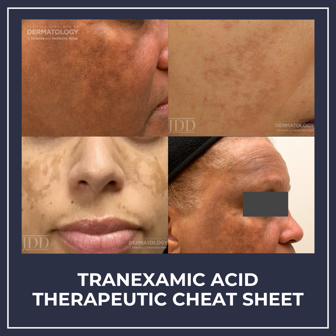Tranexamic Acid Cheat Sheet