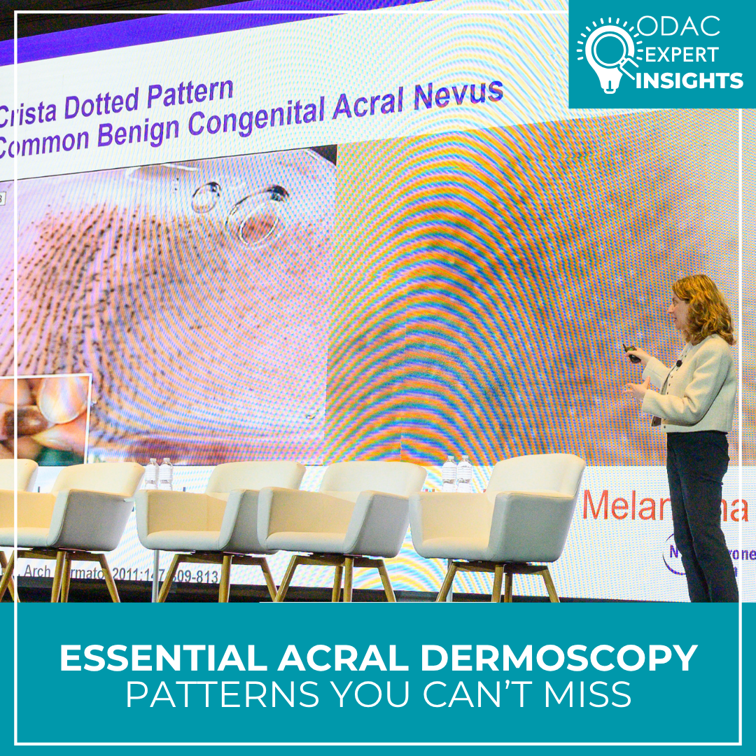Essential Acral Dermoscopy: Patterns