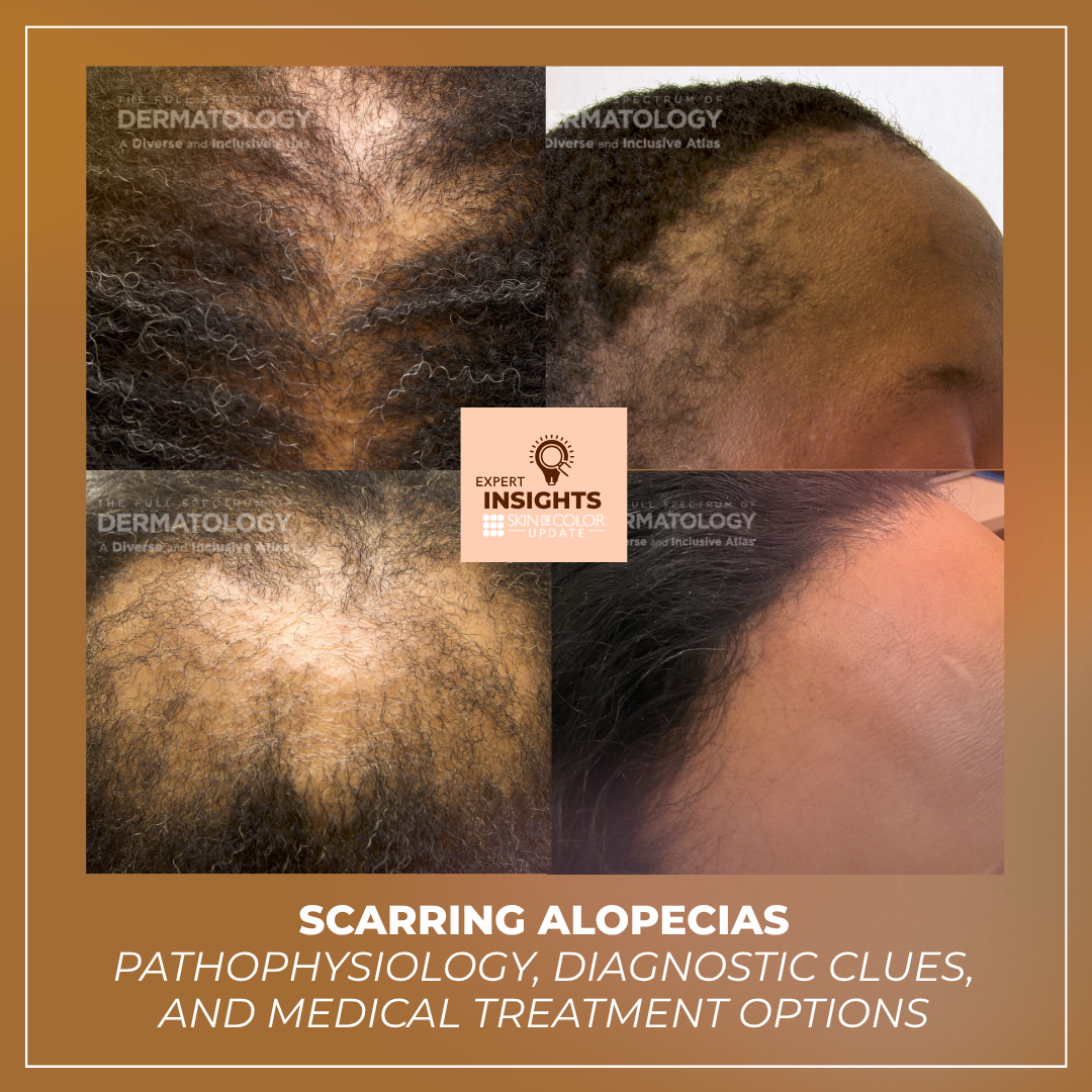 scarring alopecias in skin of color