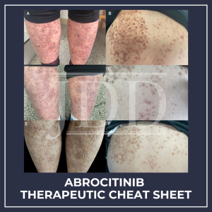 Abrocitinib Therapeutic Cheat Sheet